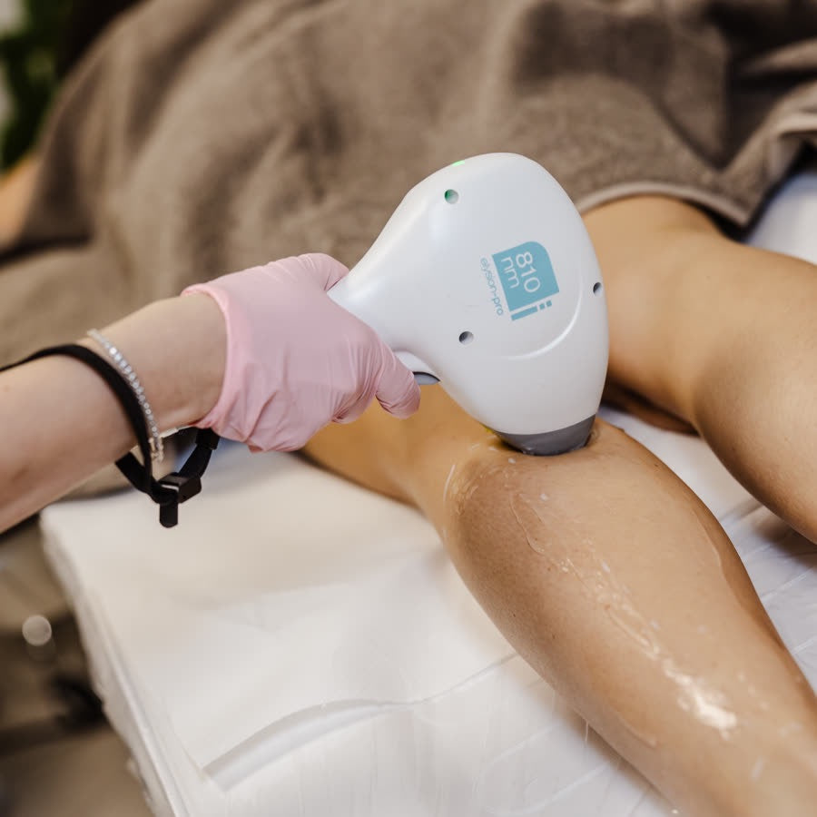 Laser hair removal